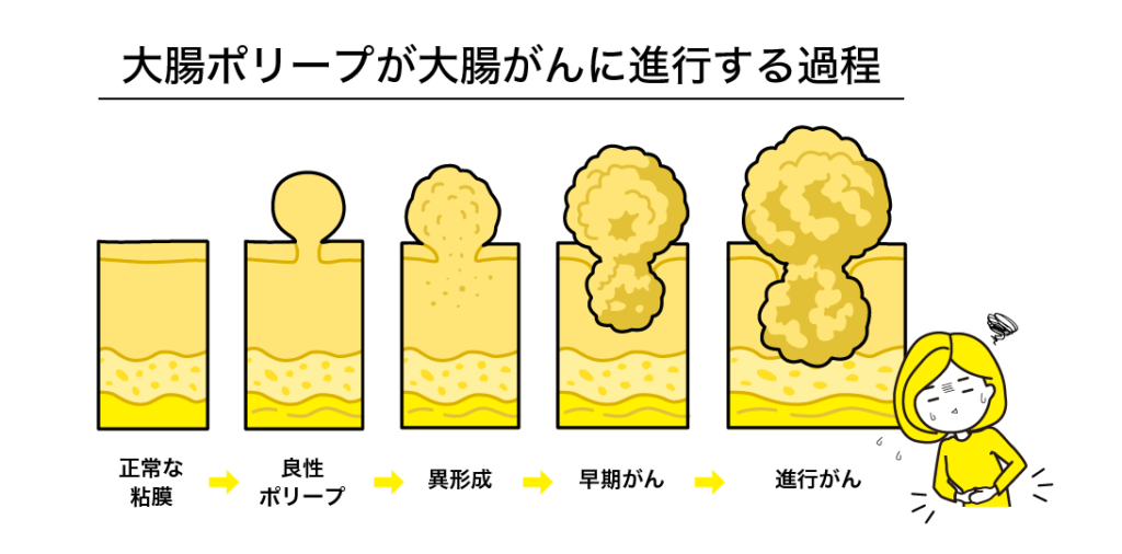 大腸ポリープは放置して大丈夫?がん化するまでの期間と進行ステップ。大腸内視鏡検査の重要性 1 260214 main